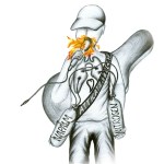 Attica! Attica! - Napalm & Nitrogen